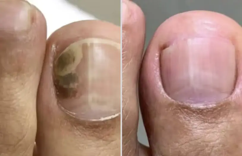 Mary T. — toenail fungus testimonial