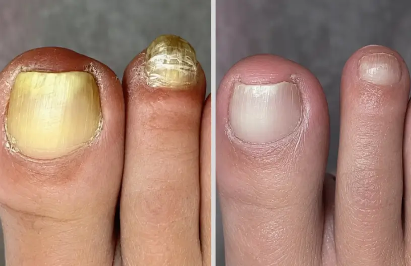 Linda R. — toenail fungus testimonial