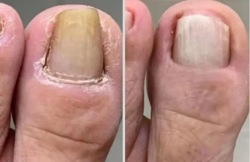 Robert M. — toenail fungus testimonial
